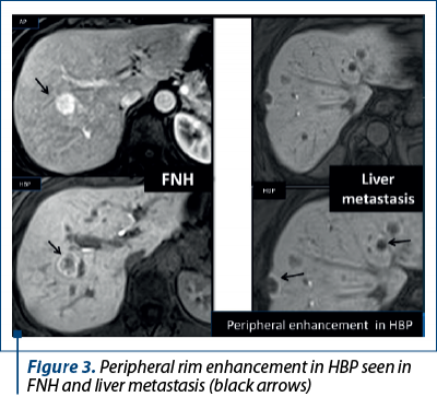 Figure 3. Peripheral rim enhancement in HBP seen in FNH and liver metastasis (black arrows)