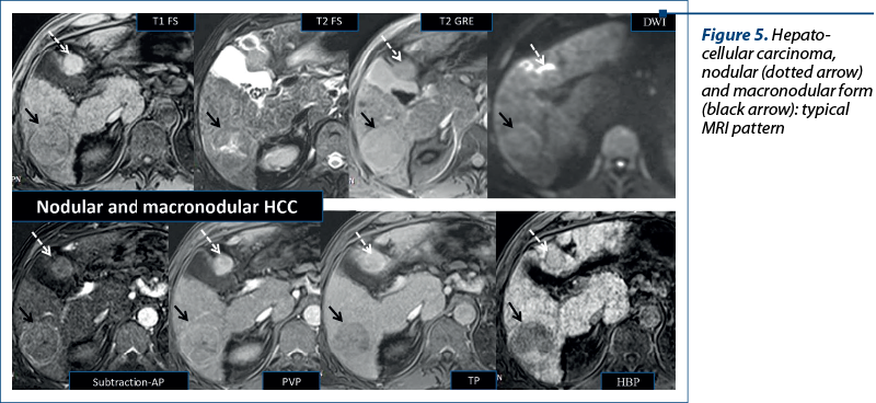 Figure 5. Hepato­cellular carcinoma, nodular (dotted arrow) and macronodular form (black arrow): typical MRI pattern