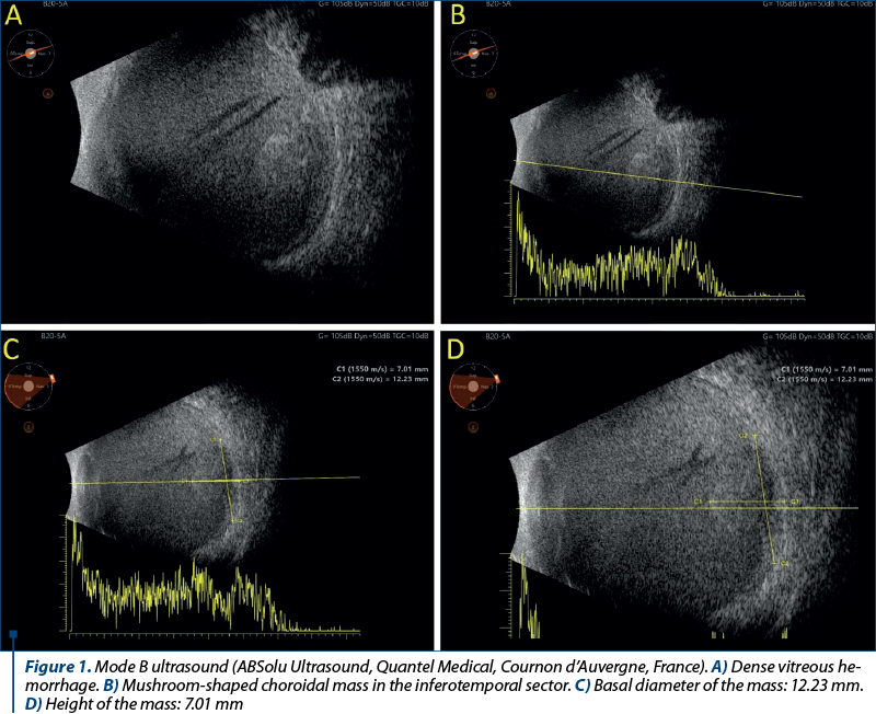 Figure 1. Mode B ul­tra­sound (ABSolu Ultra­sound, Quantel Medical, Cournon d’Auvergne, France). A) Dense vitreous he­mor­rhage. B) Mushroom-shaped choroidal mass in the inferotemporal sector. C) Basal diameter of the mass: 12.23 mm. D) Height of the mass: 7.01 mm