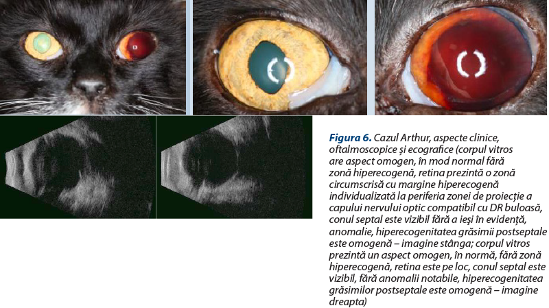 Figura 6. Cazul Arthur, aspecte clinice, oftalmoscopice şi ecografice (corpul vitros are aspect omogen, în mod normal fără zonă hiperecogenă, retina prezintă o zonă circumscrisă cu margine hiperecogenă individualizată la periferia zonei de proiecţie a capului nervului optic compatibil cu DR buloasă, conul septal este vizibil fără a ieşi în evidenţă, anomalie, hiperecogenitatea grăsimii postseptale este omogenă – imagine stânga; corpul vitros prezintă un aspect omogen, în normă, fără zonă hiperecogenă, retina este pe loc, conul septal este vizibil, fără anomalii notabile, hiperecogenitatea grăsimilor postseptale este omogenă – imagine dreapta)