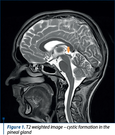 Figure 1. T2 weighted image – cystic formation in the pineal gland