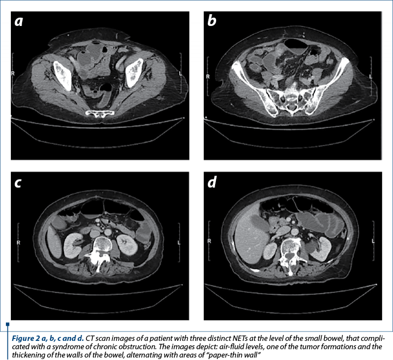 Figure 2 a, b, c and d. CT scan images of a patient with three distinct NETs at the level of the small bowel, that com­pli­cated with a syndrome of chronic obstruction. The images depict: air-fluid levels, one of the tumor formations and the thickening of the walls of the bowel, alternating with areas of “paper-thin wall”