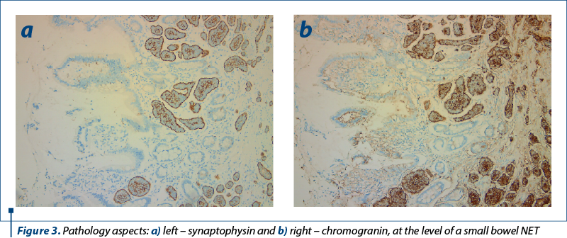Figure 3. Pathology aspects: a) left – synaptophysin and b) right – chromogranin, at the level of a small bowel NET