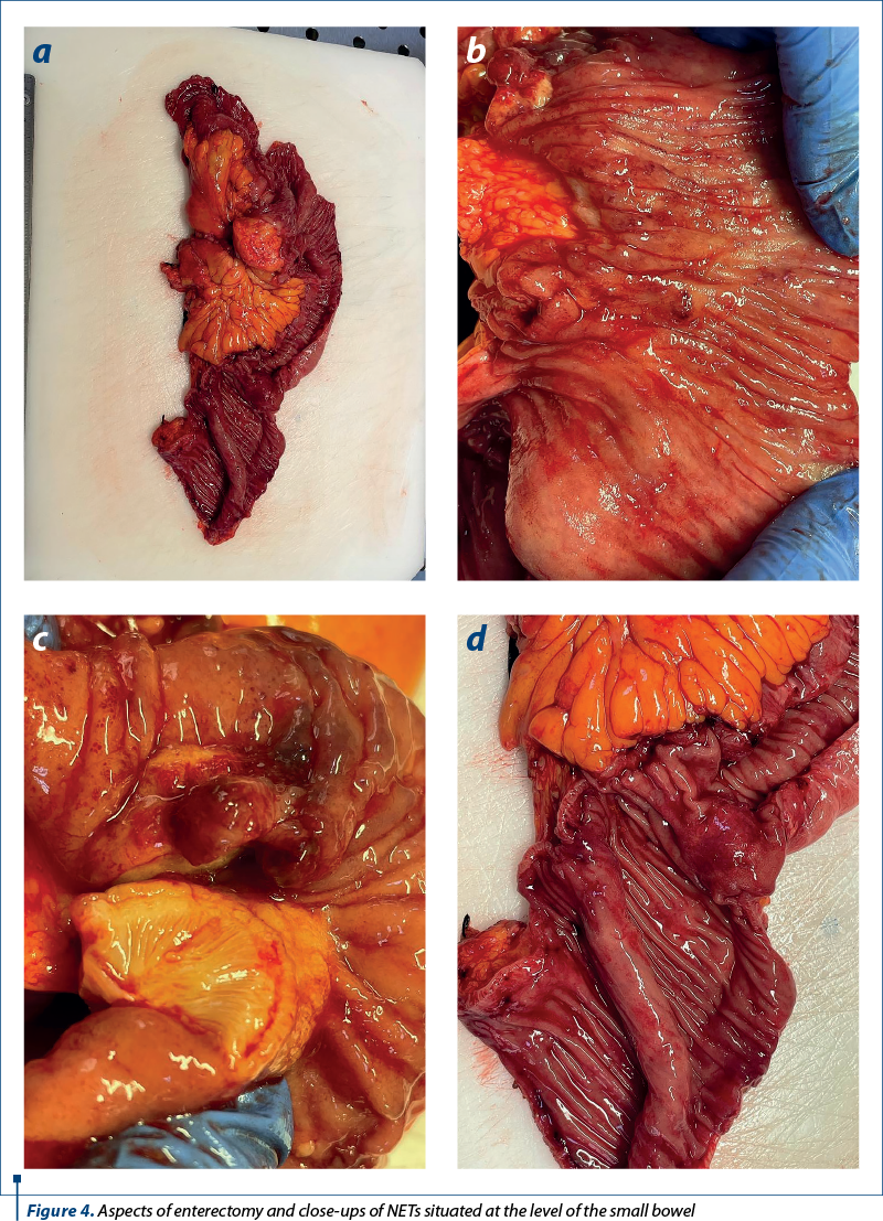 Figure 4. Aspects of enterectomy and close-ups of NETs situated at the level of the small bowel