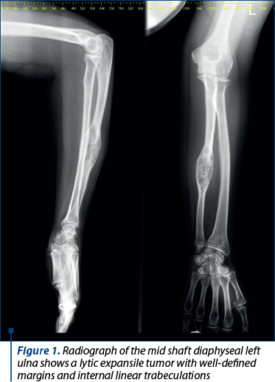 Figure 1. Radiograph of the mid shaft diaphyseal left ulna shows a lytic expansile tumor with well-defined margins and internal linear trabeculations