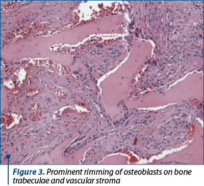 Figure 3. Prominent rimming of osteoblasts on bone trabeculae and vascular stroma