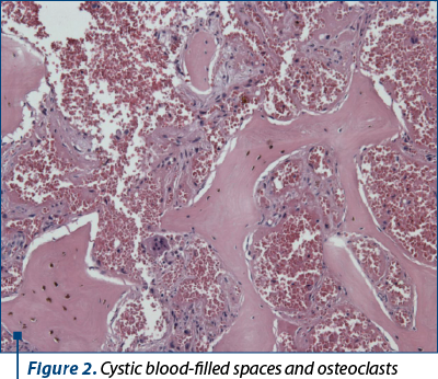 Figure 2. Cystic blood-filled spaces and osteoclasts