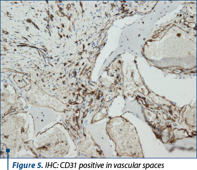Figure 5. IHC: CD31 positive in vascular spaces