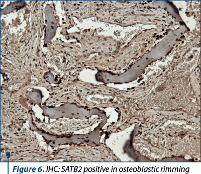 Figure 6. IHC: SATB2 positive in osteoblastic rimming