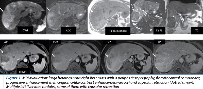 Figure 1. MRI evaluation: large heterogenous right liver mass with a peripheric topography, fibrotic central component, progressive enhancement (hemangioma-like contrast enhancement-arrow) and capsular retraction (dotted arrow). Multiple left liver lobe nodules, some of them with capsular retraction 