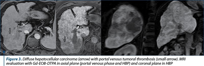 Figure 3. Diffuse hepatocellular carcinoma (arrow) with portal venous tumoral thrombosis (small arrow). MRI evaluation with Gd-EOB-DTPA in axial plane (portal venous phase and HBP) and coronal plane in HBP