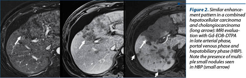 Figure 2. Similar enhance­ment pattern in a combined hepa­to­cellular carcinoma and cholangiocarcinoma (long arrow): MRI eva­lua­tion with Gd-EOB-DTPA in late arterial phase, por­tal venous phase and hepatobiliary phase (HBP). Note the presence of mul­ti­ple small nodules seen  in HBP (small arrow)