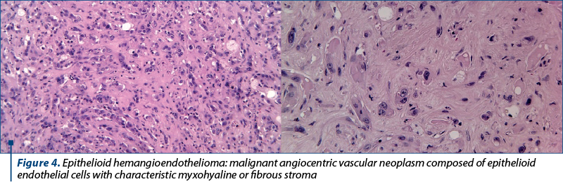Figure 4. Epithelioid hemangioendothelioma: malignant angiocentric vascular neoplasm composed of epithelioid endothelial cells with characteristic myxohyaline or fibrous stroma 