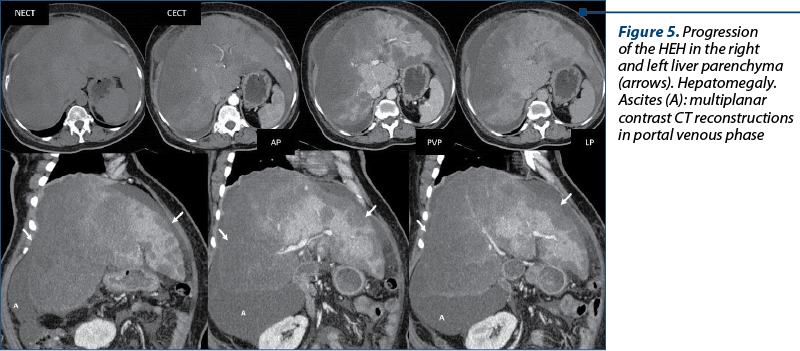Figure 5. Progression  of the HEH in the right and left liver paren­chy­ma (arrows). Hepatomegaly. Ascites (A): multiplanar contrast CT reconstructions in portal venous phase  