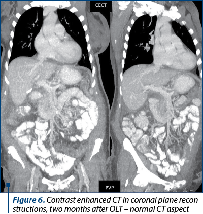Figure 6. Contrast enhanced CT in coronal plane recon­structions, two months after OLT – normal CT aspect