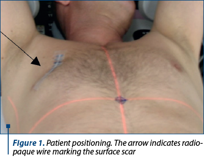 Figure 1. Patient positioning. The arrow indicates radio-paque wire marking the surface scar 