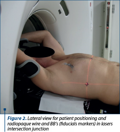 Figure 2. Lateral view for patient positioning and radiopaque wire and BB’s (fiducials markers) in lasers intersection junction