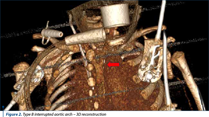 Figure 2. Type B interrupted aortic arch – 3D reconstruction
