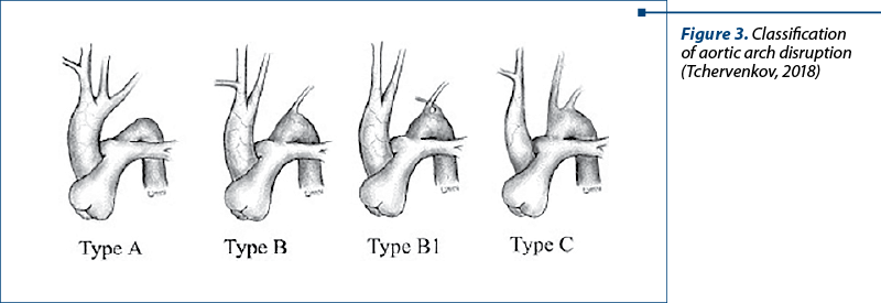Figure 3. Classification of aortic arch disruption (Tchervenkov, 2018)