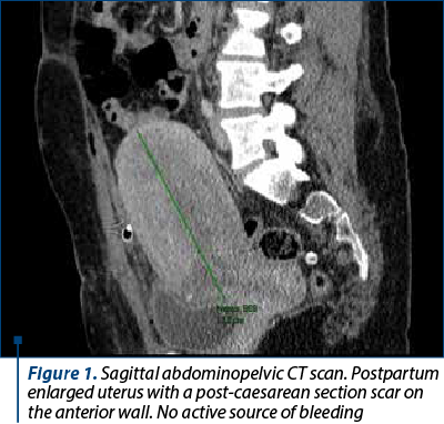 Figure 1. Sagittal abdominopelvic CT scan. Postpartum enlarged uterus with a post-caesarean section scar on the anterior wall. No active source of bleeding
