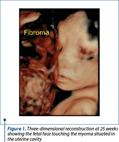 Figure 1. Three-dimensional reconstruction at 25 weeks showing the fetal face touching the myoma situated in the uterine cavity 