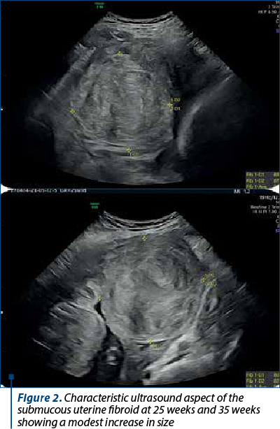 Figure 2. Characteristic ultrasound aspect of the submucous uterine fibroid at 25 weeks and 35 weeks showing a modest increase in size