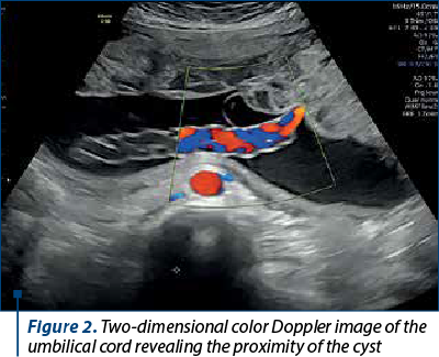 Figure 2. Two-dimensional color Doppler image of the umbilical cord revealing the proximity of the cyst