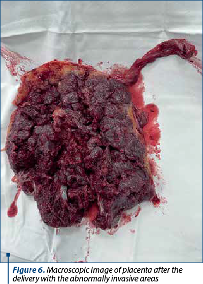 Figure 6. Macroscopic image of placenta after the delivery with the abnormally invasive areas 