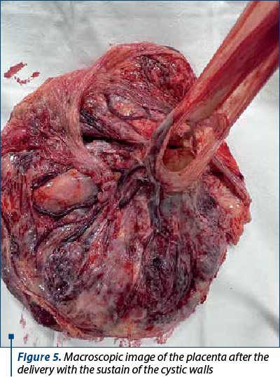 Figure 5. Macroscopic image of the placenta after the delivery with the sustain of the cystic walls