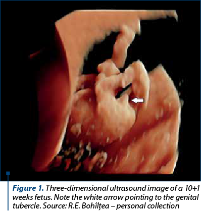 Figure 1. Three-dimensional ultrasound image of a 10+1 weeks fetus. Note the white arrow pointing to the genital tubercle. Source: R.E. Bohîlţea – personal collection