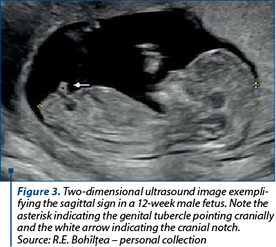 Figure 3. Two-dimensional ultrasound image exem­pli­fy­ing the sagittal sign in a 12-week male fetus. Note the asterisk indicating the genital tubercle pointing cranially and the white arrow indicating the cranial notch. Source: R.E. Bohîlţea – personal collection