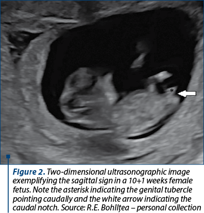 Figure 2. Two-dimensional ultrasonographic image exemplifying the sagittal sign in a 10+1 weeks female fetus. Note the asterisk indicating the genital tubercle pointing caudally and the white arrow indicating the caudal notch. Source: R.E. Bohîlţea – personal collection 