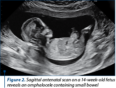 Figure 2. Sagittal antenatal scan on a 14-week-old fetus reveals an omphalocele containing small bowel