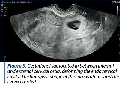 Figure 3. Gestational sac located in between internal and external cervical ostia, deforming the endocervical cavity. The hourglass shape of the corpus uterus and the cervix is noted