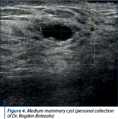 Figure 4. Medium mammary cyst (personal collection of Dr. Bogdan Botezatu)