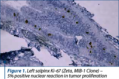 Figure 1. Left salpinx Ki-67 (Zeta, MIB-1 Clone) –  5% positive nuclear reaction in tumor proliferation