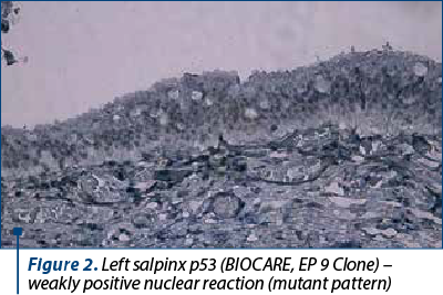 Figure 2. Left salpinx p53 (BIOCARE, EP 9 Clone) – weakly positive nuclear reaction (mutant pattern)