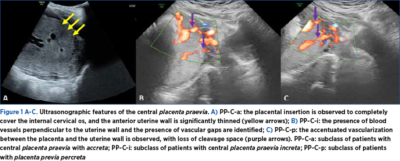 Figure 1 A-C. Ultrasonographic features of the central placenta praevia. A) PP-C-a: the placental insertion is observed to completely cover the internal cervical os, and the anterior uterine wall is significantly thinned (yellow arrows); B) PP-C-i: the presence of blood vessels perpendicular to the uterine wall and the presence of vascular gaps are identified; C) PP-C-p: the accentuated vascularization between the placenta and the uterine wall is observed, with loss of cleavage space (purple arrows). PP-C-a: subclass of patients with central placenta praevia with accreta; PP-C-i: subclass of patients with central placenta praevia increta; PP-C-p: subclass of patients with placenta previa percreta