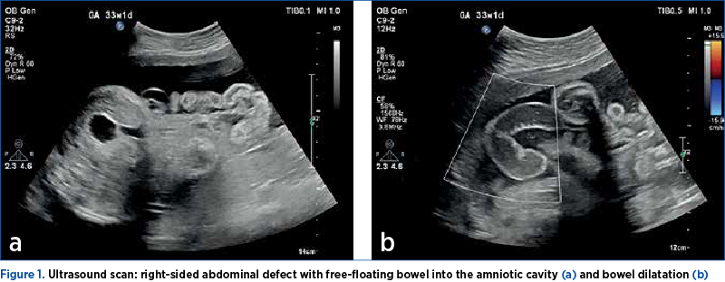 Figure 1. Ultrasound scan: right-sided abdominal defect with free-floating bowel into the amniotic cavity (a) and bowel dilatation (b)