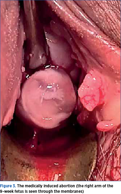Figure 3. The medically induced abortion (the right arm of the 9-week fetus is seen through the membranes)