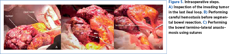 Figure 5. Intraoperative steps.  A) Inspection of the invading tumor in the last ileal loop. B) Performing careful hemostasis before segmental bowel resection. C) Performing the bowel termino-lateral anastomosis using sutures