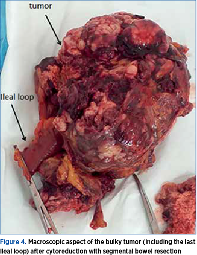 Figure 4. Macroscopic aspect of the bulky tumor (including the last ileal loop) after cytoreduction with segmental bowel resection