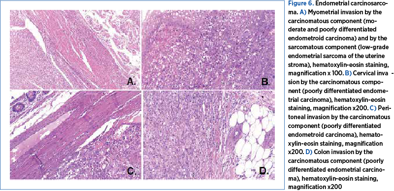 Figure 6. Endometrial carcinosar­co­ma. A) Myometrial invasion by the car­ci­nomatous component (mo­de­rate and poorly differentiated en­­do­­me­troid carcinoma) and by the sar­co­ma­tous component (low-grade en­do­me­trial sarcoma of the uterine stro­­ma), hematoxylin-eosin staining, mag­­ni­fi­ca­tion x 100. B) Cervical in­­va­­sion by the carcinomatous com­po­nent (poorly differentiated en­do­me­trial carcinoma), hematoxylin-eosin stai­ning, magnification x200. C) Pe­ri­to­neal invasion by the carcino­ma­tous component (poorly diffe­ren­tia­ted en­do­me­tro­id carcinoma), he­ma­to­xy­lin-eosin staining, magni­fi­ca­tion x200. D) Colon invasion by the car­ci­no­ma­tous component (poor­ly dif­fe­rentiated endometrial carcino­ma), hematoxylin-eosin staining, mag­ni­fi­ca­tion x200