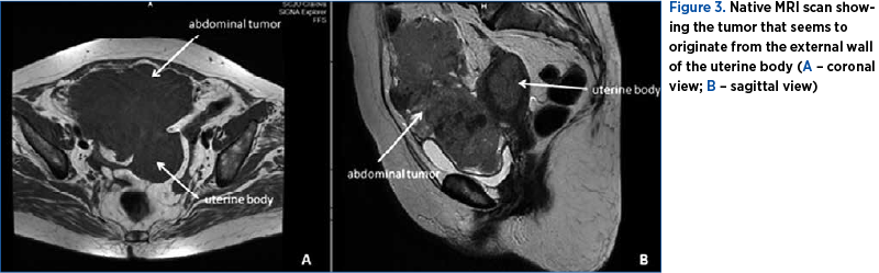 Figure 3. Native MRI scan showing the tumor that seems to originate from the external wall of the uterine body (A – coronal view; B – sagittal view)
