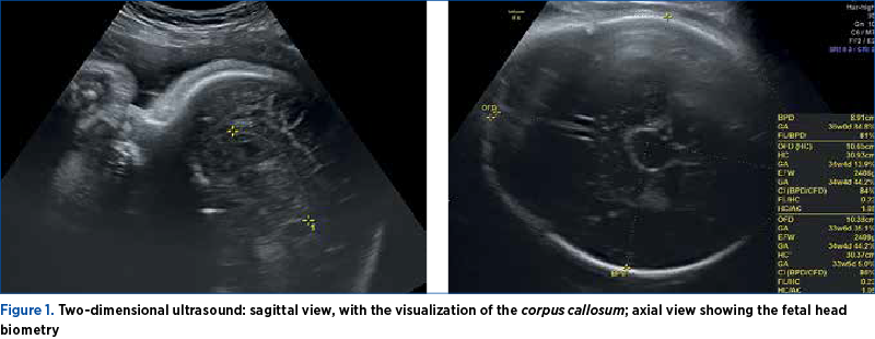 Figure 1. Two-dimensional ultrasound: sagittal view, with the visualization of the corpus callosum; axial view showing the fetal head biometry
