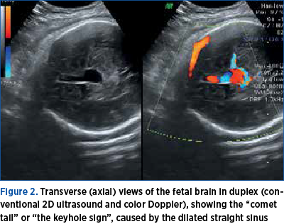 Figure 2. Transverse (axial) views of the fetal brain in duplex (conventional 2D ultrasound and color Doppler), showing the “comet tail” or “the keyhole sign”, caused by the dilated straight sinus