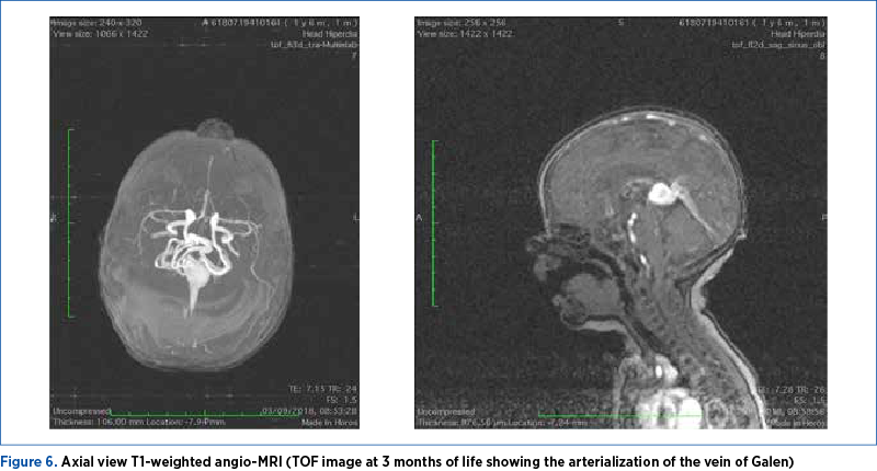 Figure 6. Axial view T1-weighted angio-MRI (TOF image at 3 months of life showing the arterialization of the vein of Galen) 
