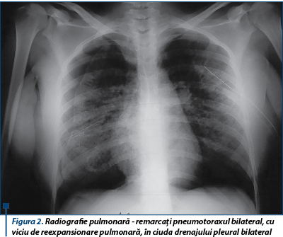 Figura 2. Radiografie pulmonară - remarcaţi pneumotoraxul bilateral, cu viciu de reexpansionare pulmonară, în ciuda drenajului pleural bilateral