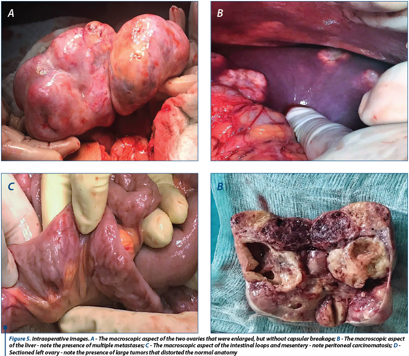 Figure 5. Intraoperative images. A - The macroscopic aspect of the two ovaries that were enlarged, but without capsular breakage; B - The macroscopic aspect of the liver - note the presence of multiple metastases; C - The macroscopic aspect of the intestinal loops and mesentery - note peritoneal carcinomatosis; D - Sectioned left ovary - note the presence of large tumors that distorted the normal anatomy