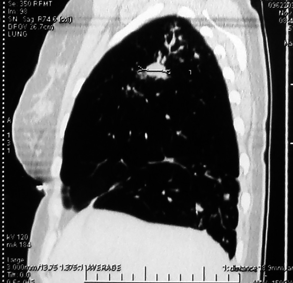Figura 4. Tablou de tuberculoză infiltrativă cu evoluție fibrocirotică și formarea tuberculomului în lobul superior și mediu al plămânului drept. Fibroatelectazia S7 și S10 a plămânului drept